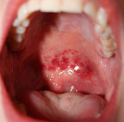 Nguyên nhân gây bệnh viêm họng