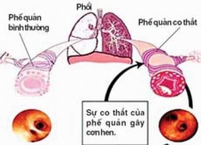 Kết quả hình ảnh cho viêm phế quản co thắt