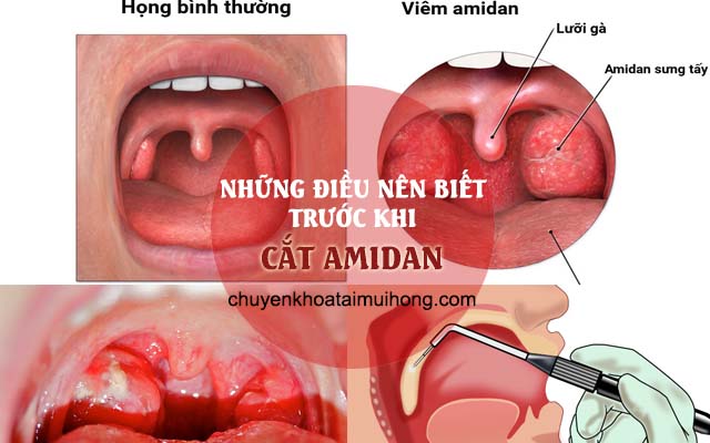 Lưu ý trước khi cắt amidan