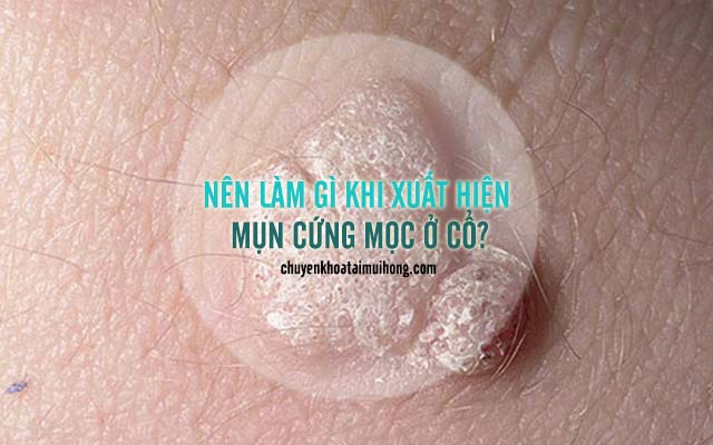 Nên làm gì khi mụn cứng mọc ở cổ