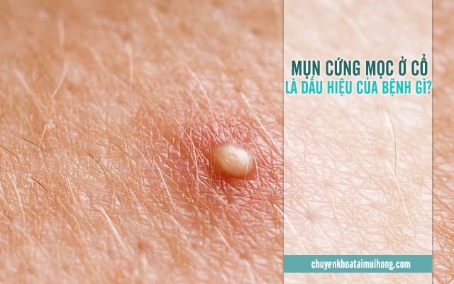 Mọc mụn cứng ở cổ là dấu hiệu của bệnh gì? 