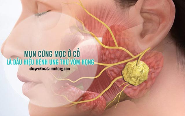 Mụn cứng mọc ở cổ dấu hiệu ung thư vòm họng