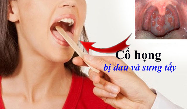 Viêm họng khiến cổ họng bị đau và sưng tấy