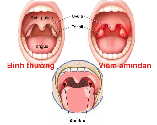 Phương pháp điều trị viêm amidan quá phát