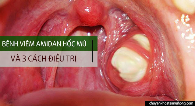 Viêm amidan hốc mủ Viêm amidan hốc mủ