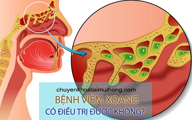 Bị viêm xoang có chữa được không?
