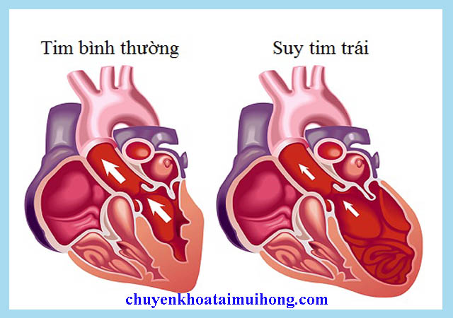 Viêm amidan hốc mủ gây ra các biến chứng nguy hiểm Viêm amidan hốc mủ gây ra các biến chứng nguy hiểm