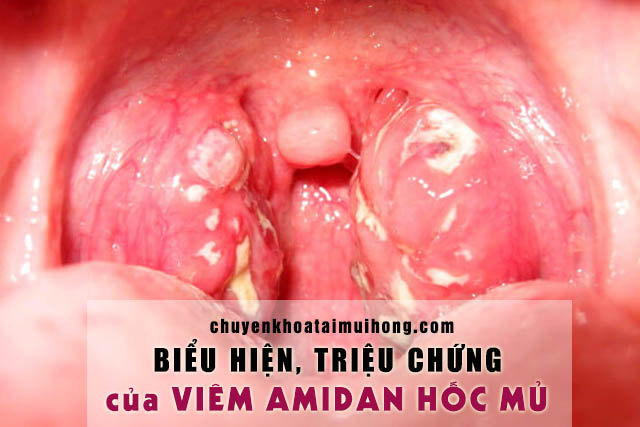 Biểu hiện, triệu chứng của viêm amidan hốc mủ