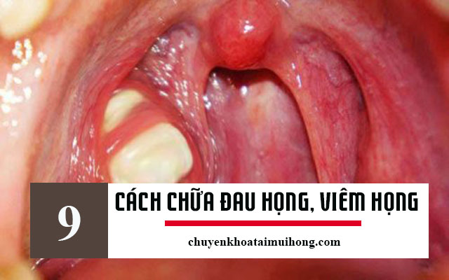 Cách chữa đau họng, viêm họng hiệu quả Cách chữa đau họng, viêm họng