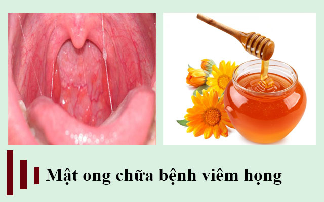 Mật ong chữa bệnh viêm họng