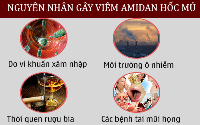 Các nguyên nhân chính gây bệnh viêm amidan hốc mủ Các nguyên nhân chính gây bệnh viêm amidan hốc mủ