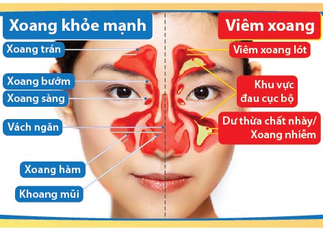 Phương pháp điều trị bệnh viêm đa xoang