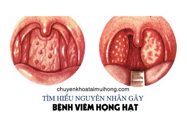 Nguyên nhân chính gây viêm họng hạt