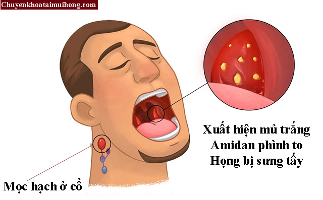 Một số triệu chứng bệnh viêm amidan hốc mủ Một số triệu chứng bệnh viêm amidan hốc mủ