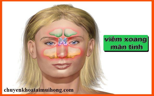 Triệu chứng điển hình của bệnh viêm xoang mãn tính Triệu chứng điển hình của bệnh viêm xoang mãn tính