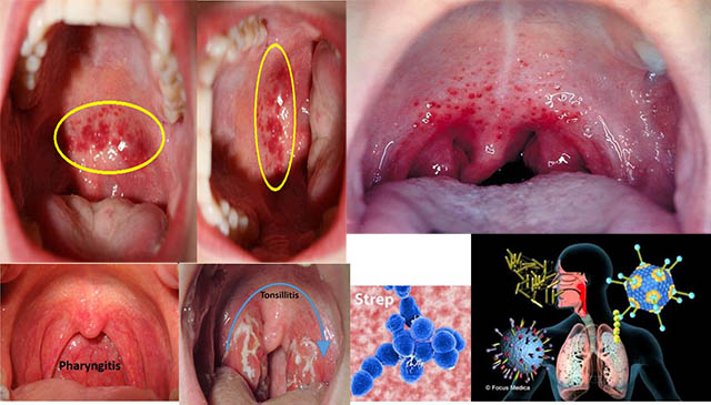 Viêm họng hạt gây nổi nhiều hạt ở họng