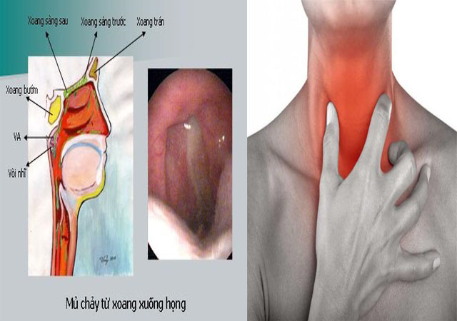 Đau hong, ho - Biểu hiện của bệnh viêm họng