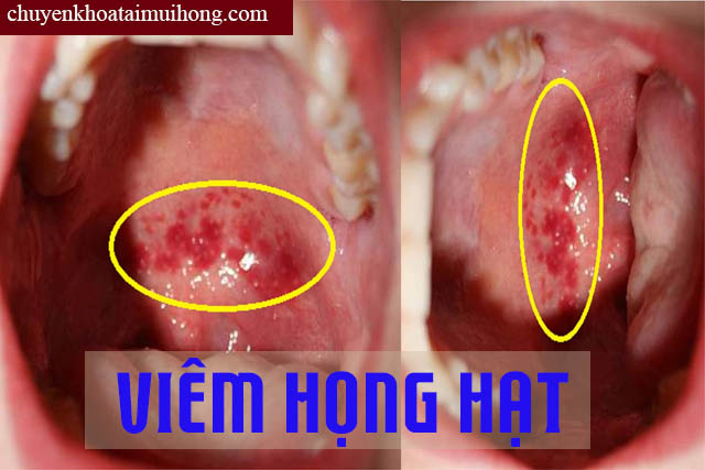 Bệnh viêm họng hạt là gì? Bệnh viêm họng hạt