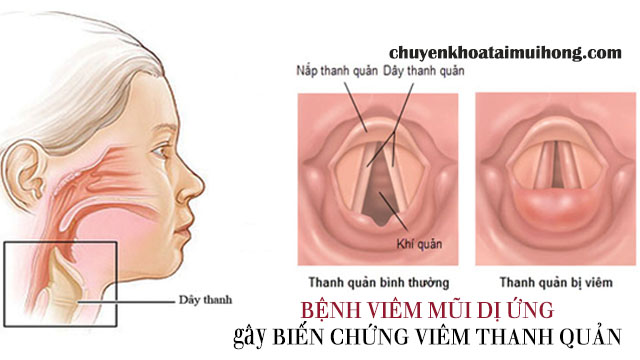 Biến chứng về đường hô hấp khi bị viêm mũi dị ứng