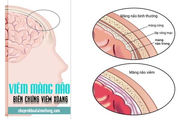 Biến chứng của viêm xoang