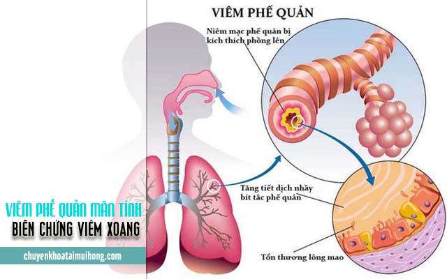 Biến chứng bệnh viêm xoang