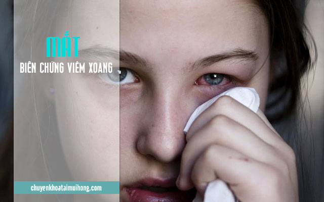 Biến chứng viêm xoang ở mắt