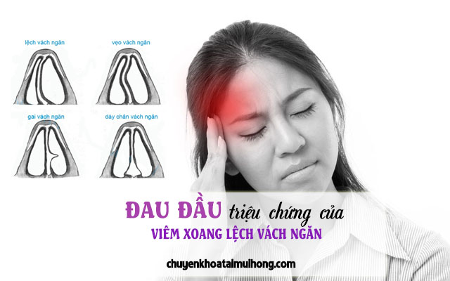 Viêm xoang lệch vách ngăn gây đau đầu