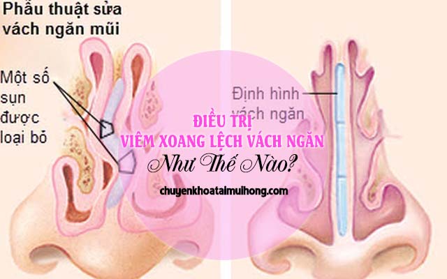 Cách trị viêm xoang lệch vách ngăn