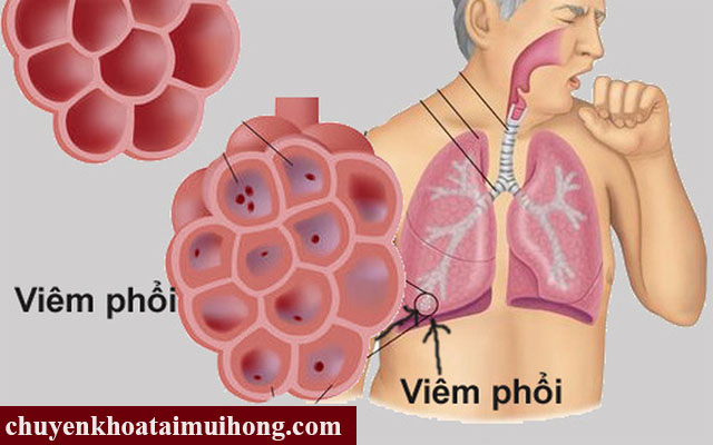 Viêm phổi gây ho kéo dài