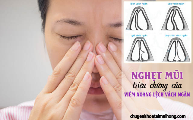 Triệu chứng viêm xoang lệch vách ngăn