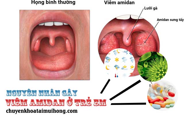 Nguyên nhân gây bệnh viêm amidan ở trẻ em