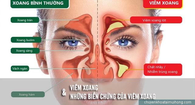 Biến chứng bệnh viêm xoang