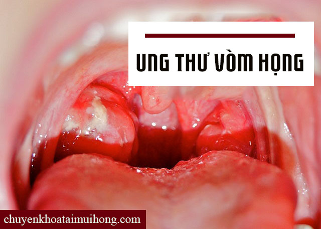 Ảnh hưởng của bệnh viêm họng hạt Ảnh hưởng của bệnh viêm họng hạt