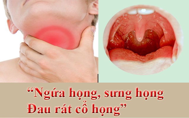 Triệu chứng bệnh viêm họng Triệu chứng bệnh viêm họng