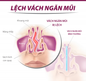 Triệu chứng viêm xoang lệch vách ngăn