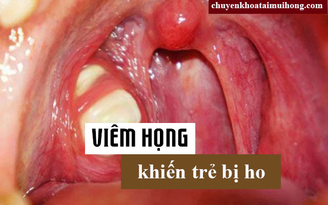 Trẻ sơ sinh bị ho do viêm họng cấp