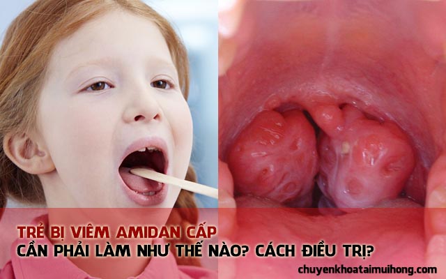 Bệnh viêm amidan cấp ở trẻ em