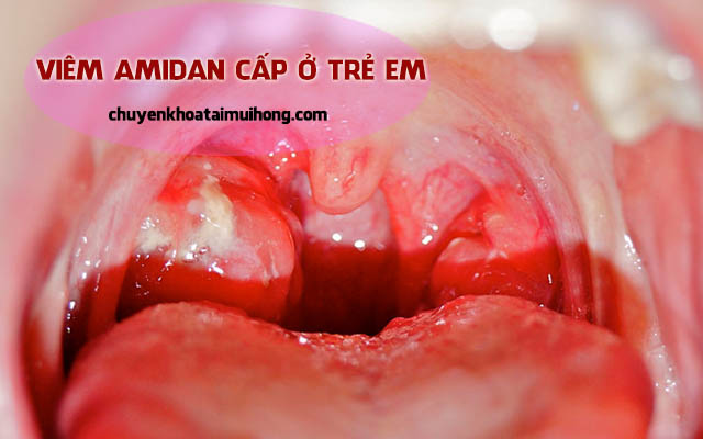 Viêm amidan cấp ở trẻ em