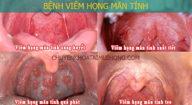 viêm họng mãn tính uống thuốc gì