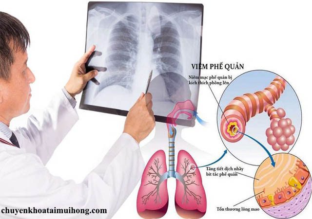 Tìm hiểu về bệnh viêm phế quản Tìm hiểu về bệnh viêm phế quản