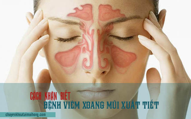 Cách nhận biết bệnh viêm xoang mũi xuất tiết