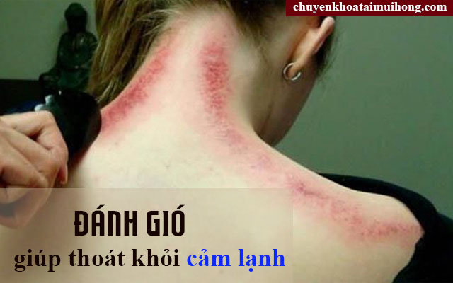 Điều trị bệnh cảm lạnh bằng cách đánh gió Điều trị bệnh cảm lạnh bằng cách đánh gió