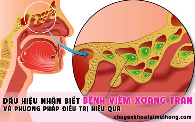Dấu hiệu nhận biết bệnh viêm xoang trán và phương pháp điều trị hiệu quả