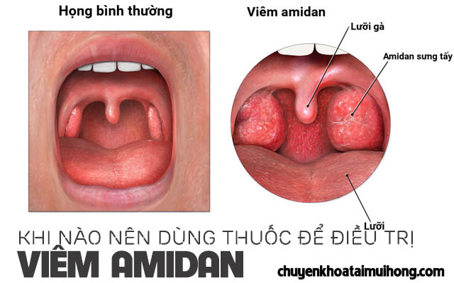 Khi nào nên dùng thuốc điều trị viêm amidan?