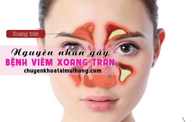 Mắc bệnh viêm xoang trán do đâu?