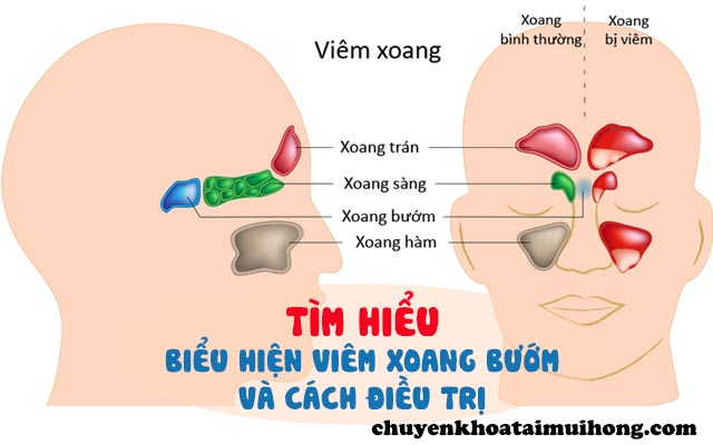 Bệnh viêm xoang bướm