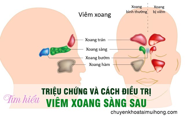 Triệu chứng và bài thuốc điều trị viêm xoang sàng sau hiệu quả