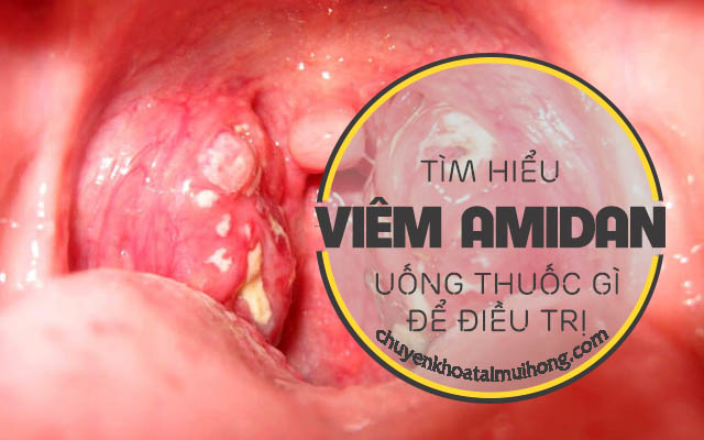 Tìm hiểu viêm amidan nên uống thuốc gì để điều trị?