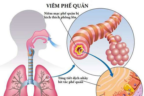 Bệnh viêm phế quản