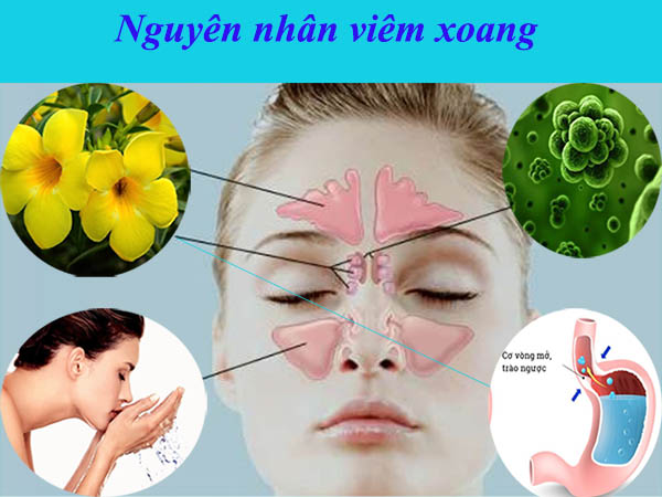 Một số nguyên nhân gây ra bệnh viêm xoang